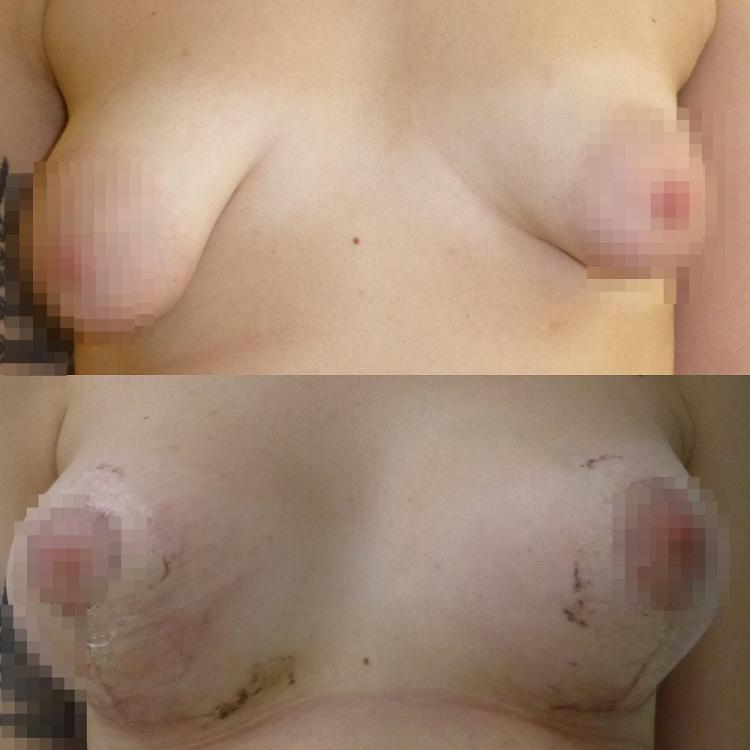 сергеев до и после операции тубулярная грудь.jpg